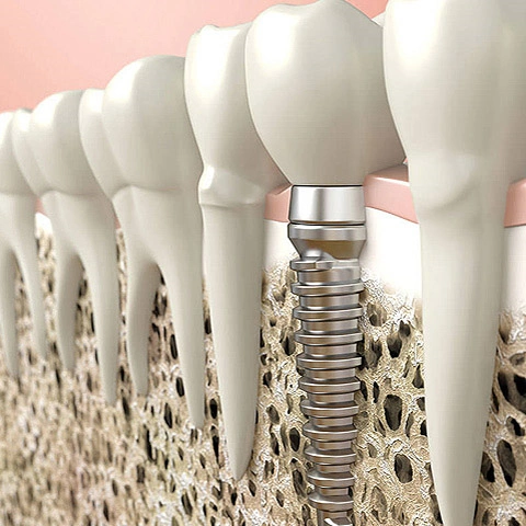 Dental Implants